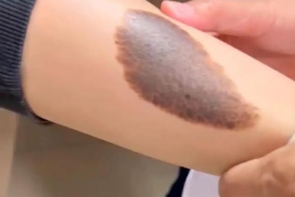 腿上不同位置的胎记算命