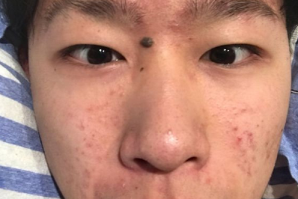 男人有观音痣的人命怎么样